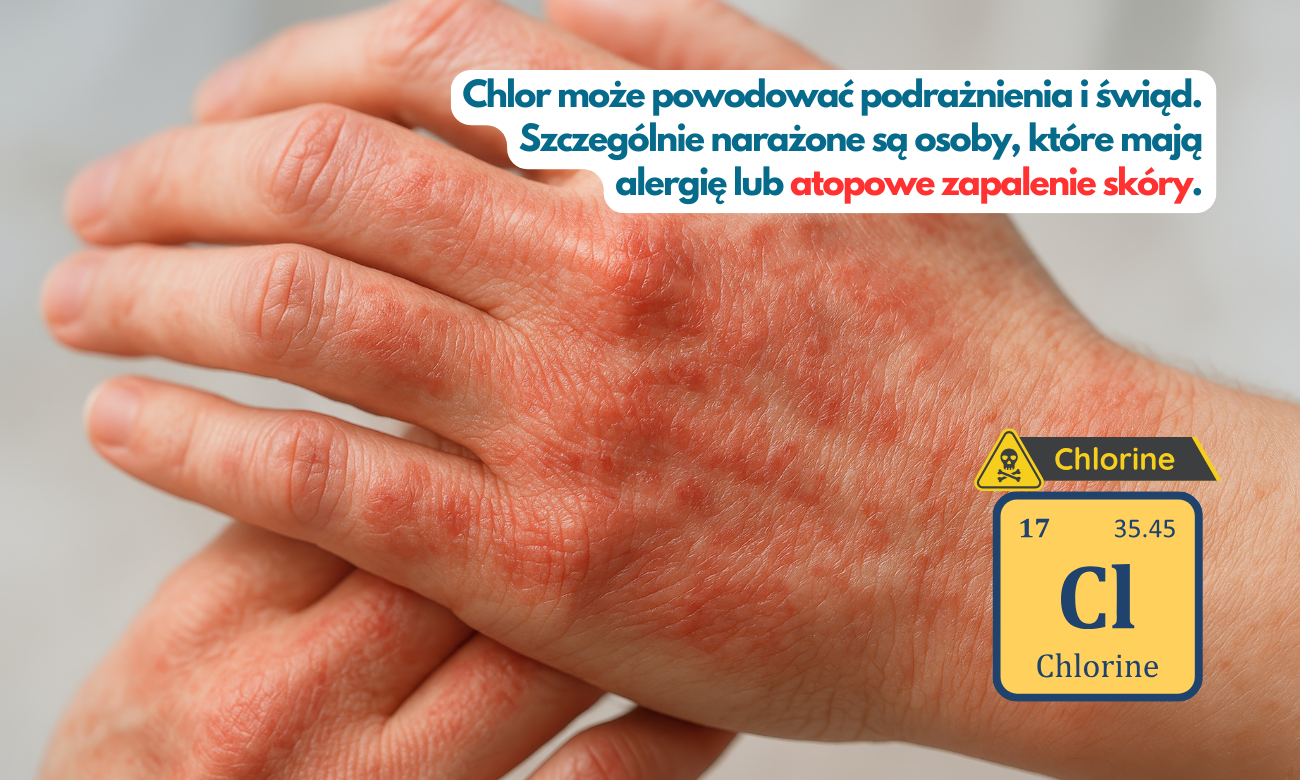 Atopowe zapalenie skóry spowodowane chlorem w wodzie.
